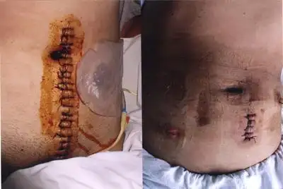 腹腔镜巧除大肠癌 医院新闻 -江苏省苏北人民医院