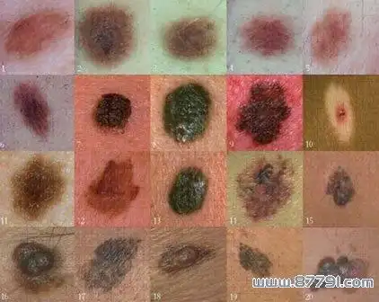 皮肤癌早期症状图片皮肤癌早期症状的一般表现