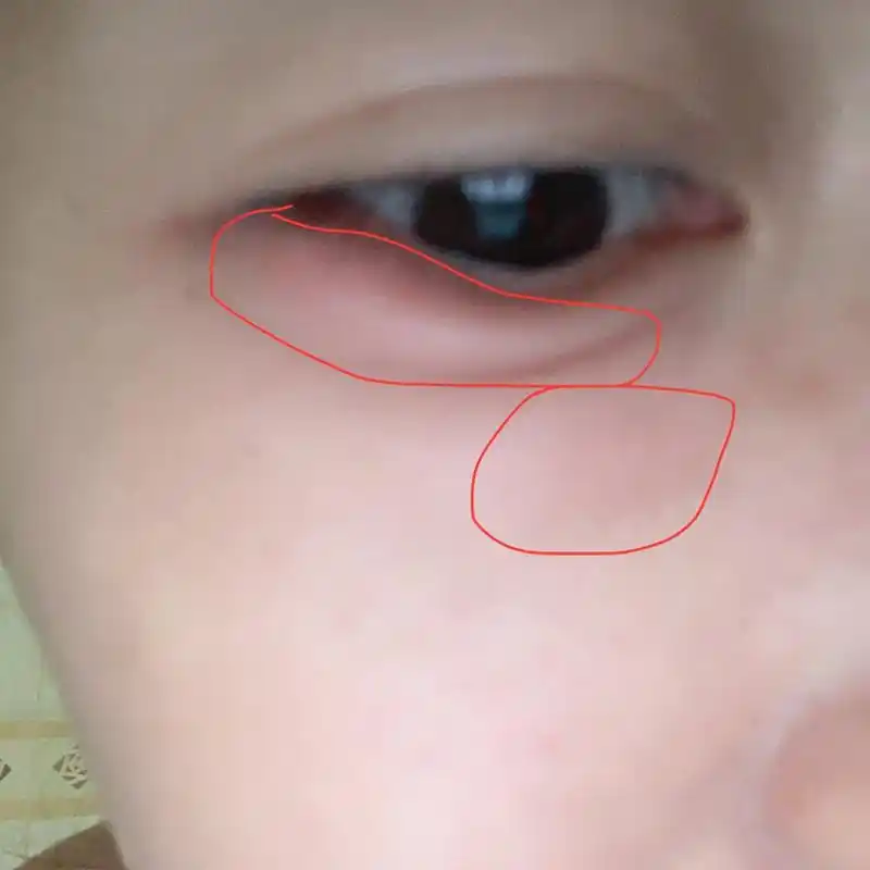 周一开始眼睛下面开始疼没有在意,直到周三开始严重红肿疼,已我们老话