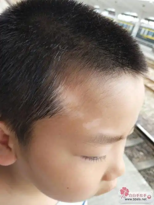 儿童治疗版-白白手拉手-手拉手白癜风论坛-白癜风患者的网上家园!