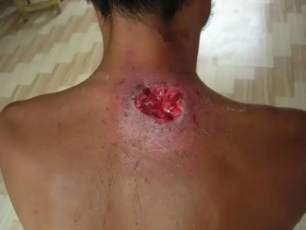 搭背疮之上搭手生于肺腧穴图片