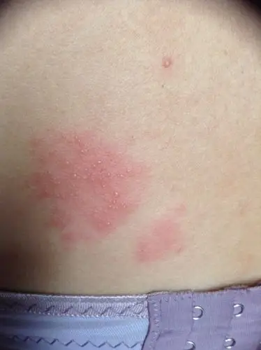 问:请问医生们,这是什么皮肤病? 症状: 又痒又痛.