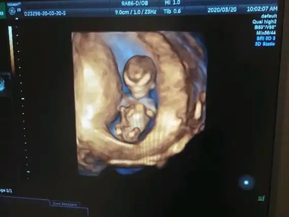 对于好奇胎儿性别的人,自然也不会这么轻易的就放弃,虽然12周b超男女