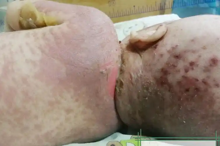 新生宝宝全身皮肤溃烂只因家长一个错误举动