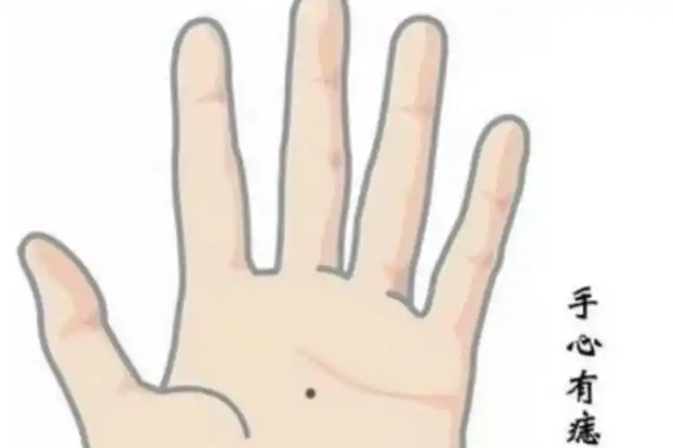 手掌长痣解读(手掌长颗痣,是什么手相)