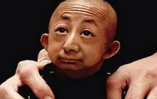 世界上体重最轻的人:成年体重仅5.45公斤(出生仅600克)