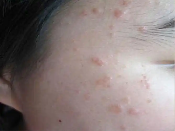 右脸的皮肤丝状疣的图片