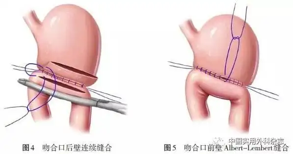 建议:推荐采用直线切割吻合器,选择残胃大弯侧行胃空肠侧侧吻合,因其