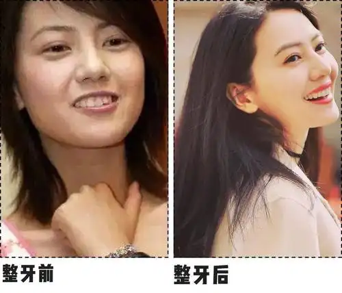 就比如说,我知道的很多明星, 变美也都是从整牙开始的,整了牙整个人
