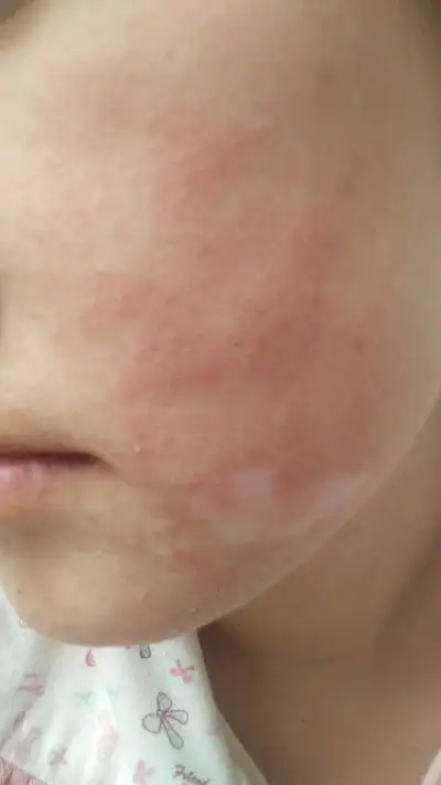 过敏性湿疹会遗传吗?