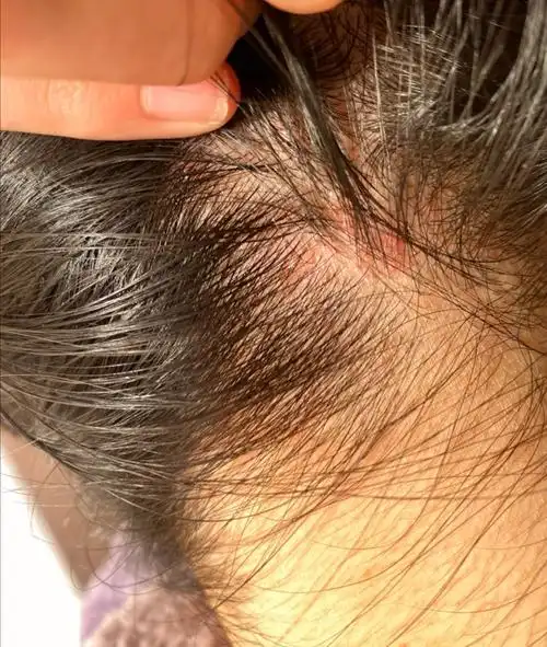 在天猫买的商品使用后头皮过敏,大片红肿_天猫客服售后投诉维权中心-3