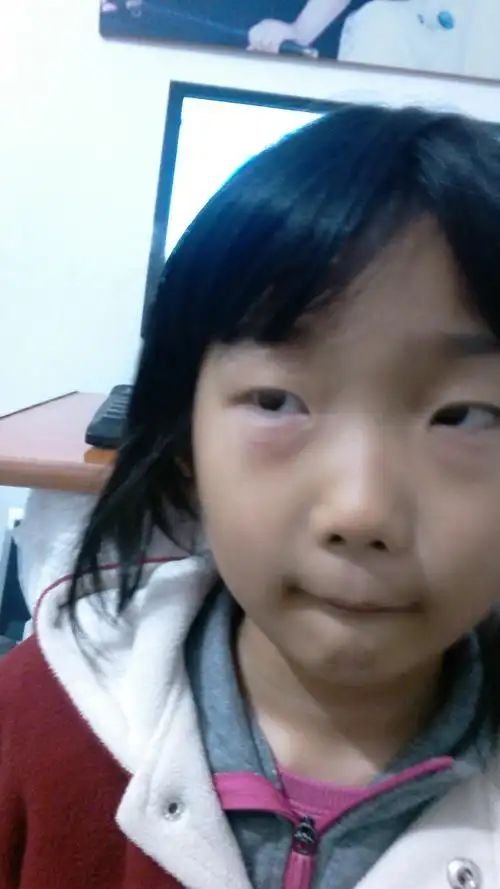 7岁小孩眼袋起水泡能自行消退但是会反复再起