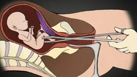 人流是如何"打掉"孩子的?3d动画演绎,看完一阵心酸