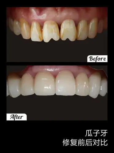 美加超薄美牙贴面适用于所有想要改善牙齿颜色和形态的人,都可以通过