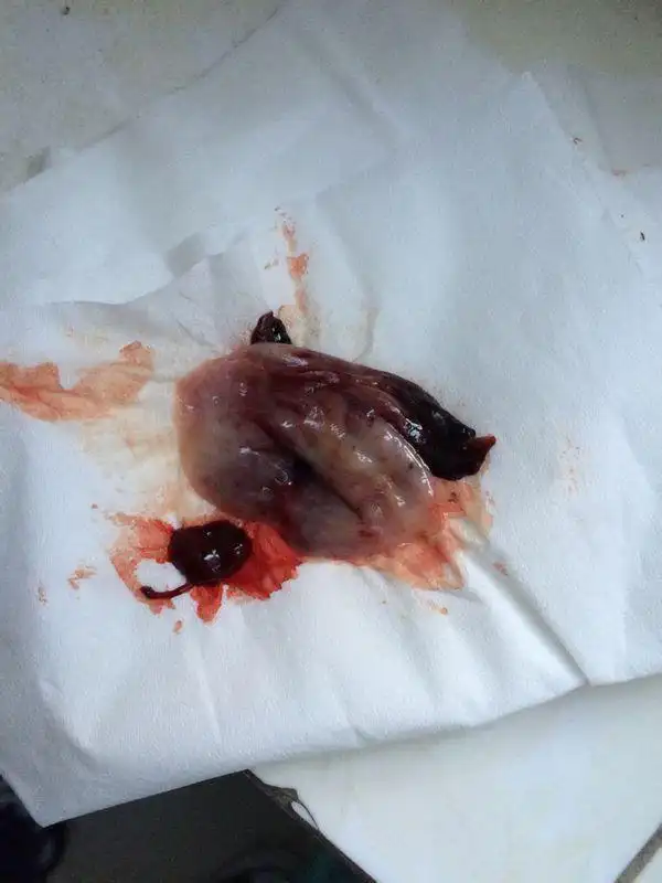 医生开的达英35吃,吃了21天后,停药第6天来月经