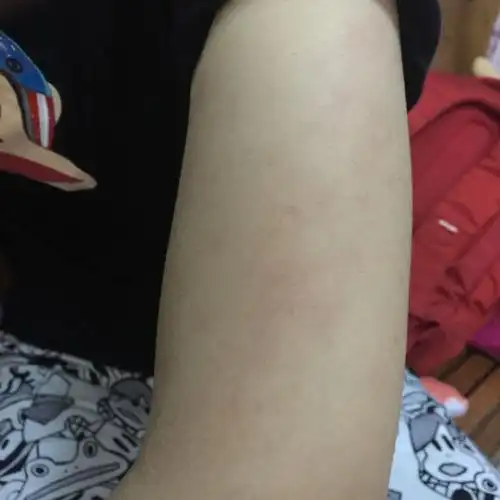 请问我有乙肝携带 想问问乙肝的话会在皮肤有什么反应么?