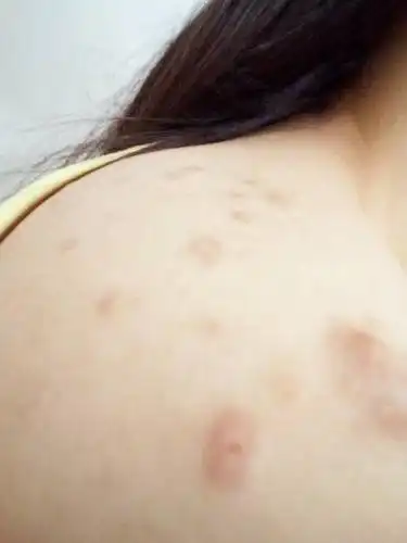 背上和肩膀上长了这些疙瘩好多年了,去医院检查医生说是毛囊炎,开了