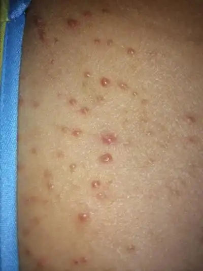 疥疮图片_疥疮症状表现图片大全_有来医生