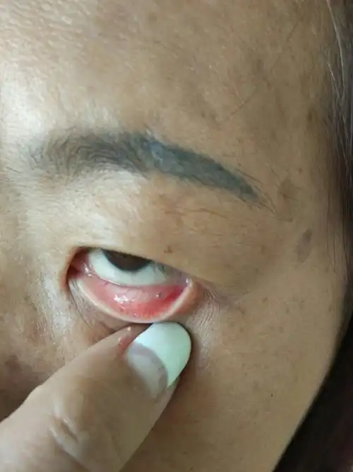 如何预防和治疗眼睑上长小颗粒?