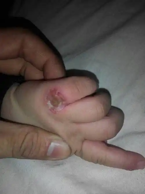 宝宝手指溃烂,干裂. 先是破皮出血,然后溃烂发炎一直不好.