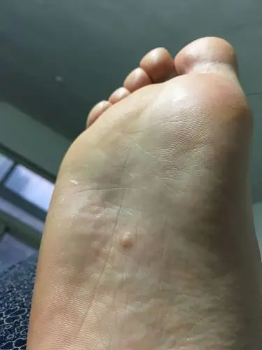 脚上长个小包,刚开始,是一个特别小的小包,现在这么大了,使劲按压,有