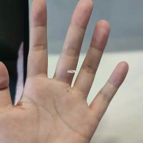 手心长痣