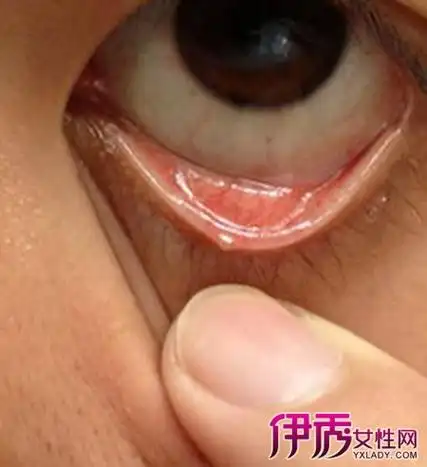 【图】下眼睑长了麦粒肿图片反馈 告诉你3个治疗此炎症的好方法