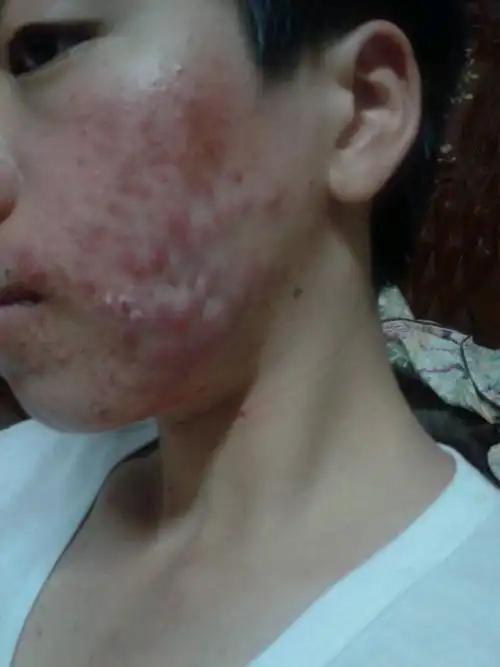 艾滋病起什么样的疙瘩疙瘩种类多且万万不能挠