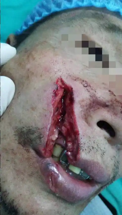 诊间| "要技术,还要风度"当严重面部切割伤遇到完美缝合技术