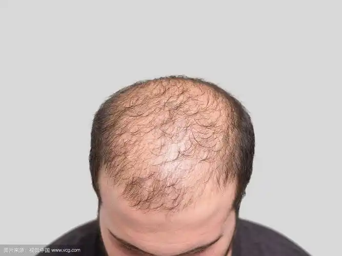 秃头的年轻人,正面