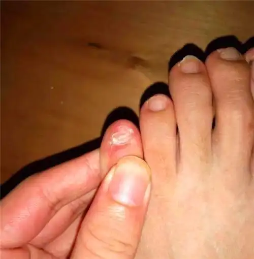 如果你脚趾有这个特征那你可能不是正宗汉族人而是鲜卑人后代