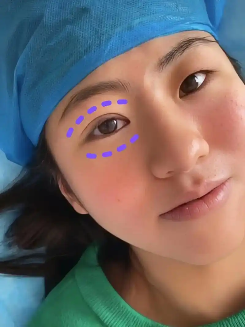 (经验篇)全切双眼皮前一定要知道的事!我术后的双眼皮恢复的超 - 抖音