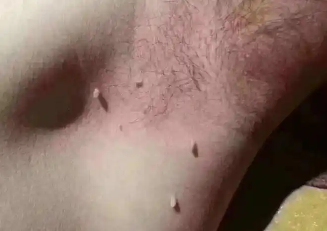 女子腋下长满"小肉条",因确诊感染hpv?医生:切忌别再扣了