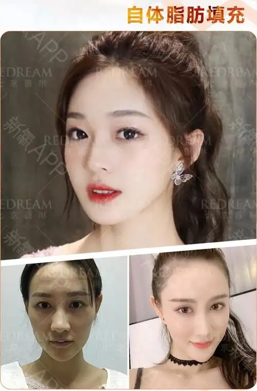 面部填充案例分享#全面部脂肪填充现在我们提起的面部_圈子-新氧美容