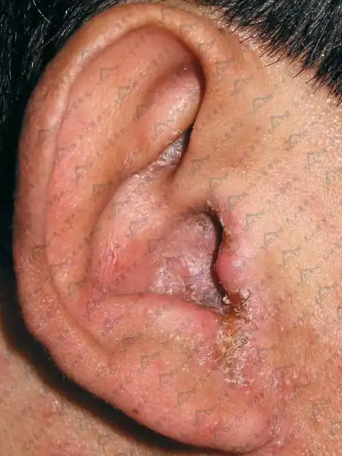 湿疹:病因,症状,诊断治疗详解