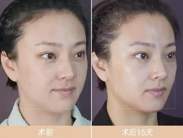 改善皮肤轻度下垂感,提升肌肤紧实度!
