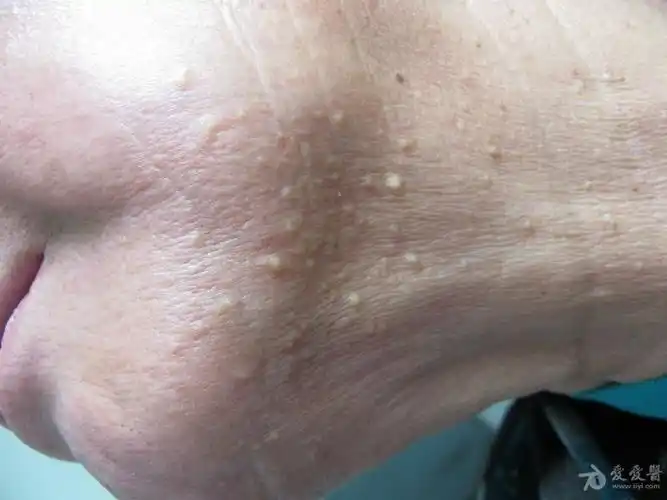 颈部结节---粟丘疹 - 皮肤及性传播疾病讨论版 - 爱爱医医学论坛