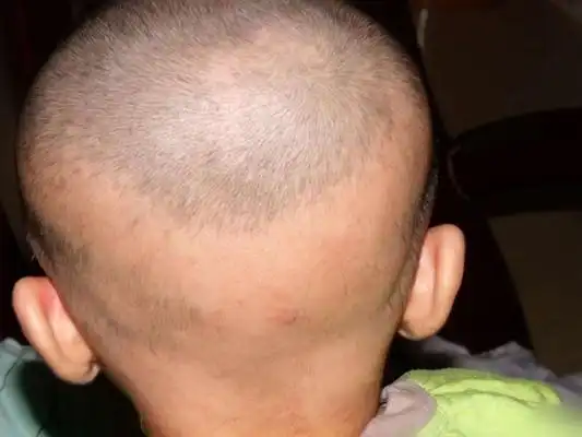 新生儿佝偻病图片_新生儿佝偻病症状表现图片大全_有来医生