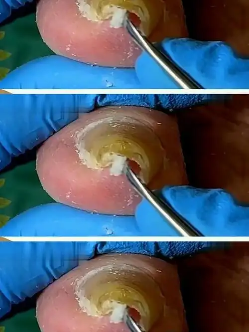 疼麻了,这是扎了根钉子进去呀