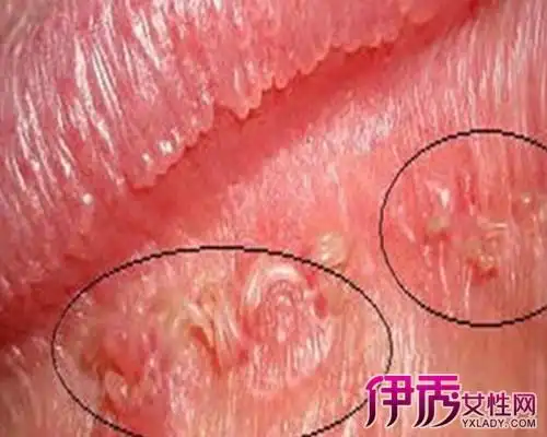 【图】女尖锐湿疣症状图片 告诉你2个病症的早期症状