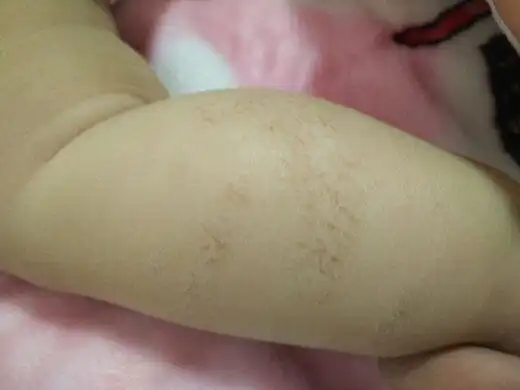 皮肤长癣十个月宝宝腿上胳膊上长干癣,有没有宝宝跟我_妈妈网孕育社区