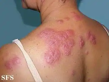 急性发热性嗜中性皮肤病(sweets syndrome)09