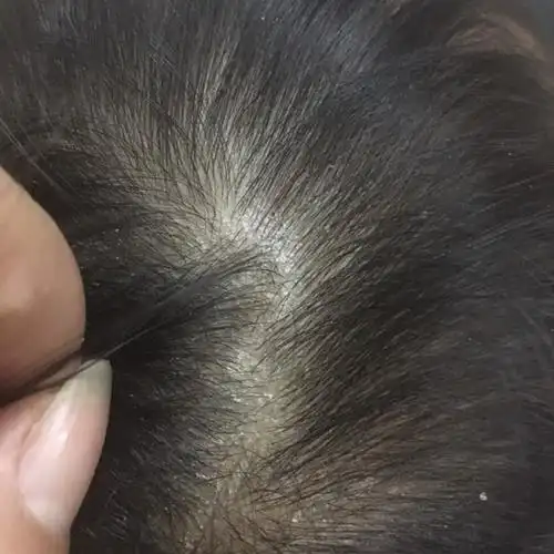 女儿头上有一小片很多头皮