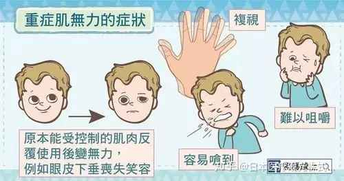 一部份的重肌无力症患者症状局限于眼睛,出现眼睑麻痹下垂与复视的