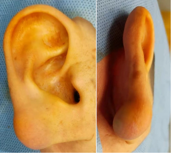 典型病例耳廓包块皮脂腺囊肿