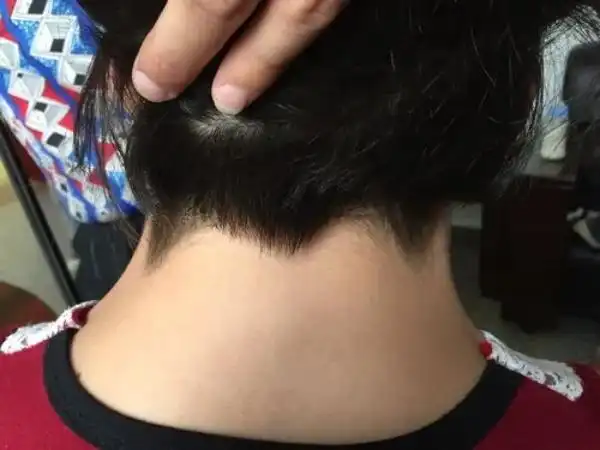 turner综合征症状之一后发际低