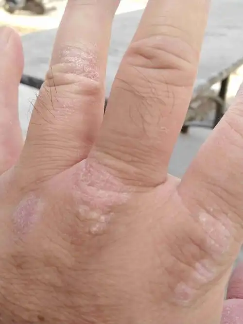 时不时有点痒,易复发,请问这个什么皮肤病,该用什么药,谢谢?