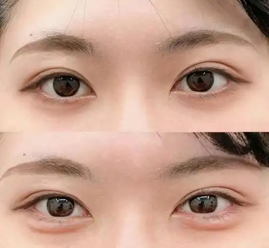 本文将介绍卧蚕的类型以及玻尿酸填充卧蚕的用量,效果,并解答了一些