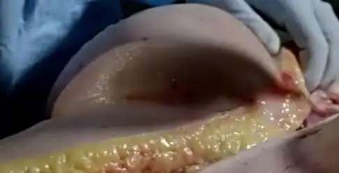 皮下脂肪不算啥,要命的是内脏脂肪,该减减你的啤酒肚了!