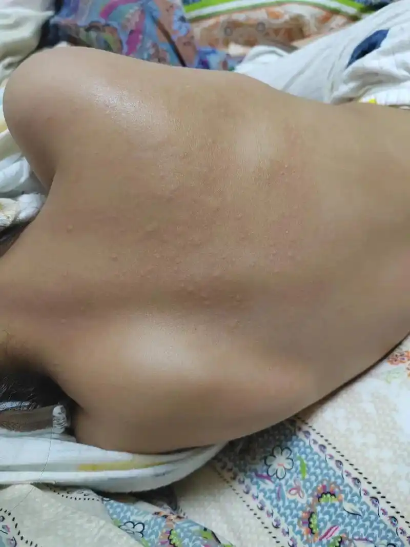 大晚上突然说痒死了,开灯发现背上都是疹子